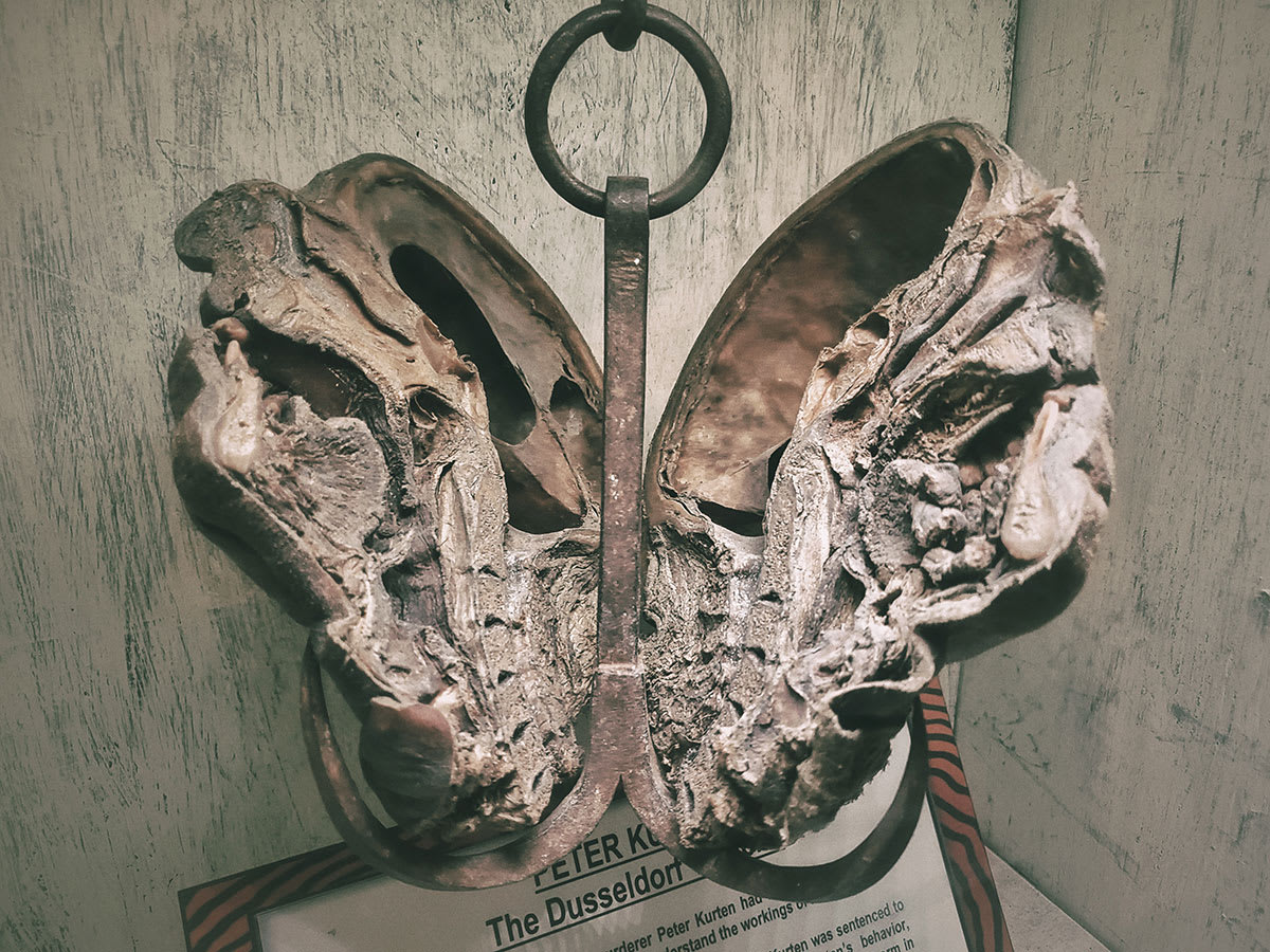 Peter Kürten koponya preparátum második nézet törvényszéki kutatás történelmi tanulmány sorozatgyilkos anatómia