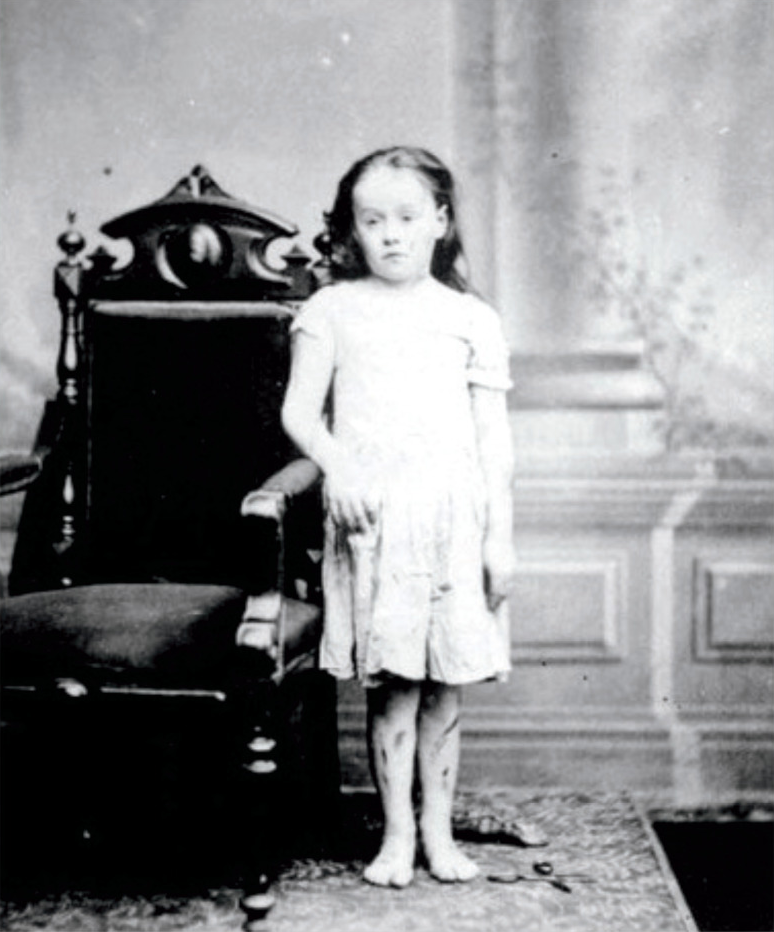 Mary Ellen Wilson gyermekbántalmazás áldozata 1874 elhanyagoltság sebezhetőség gyermekvédelem történet amerikai történelem